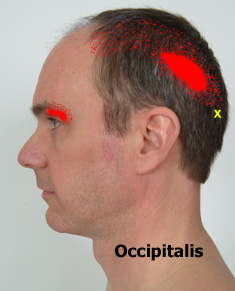 Occipitalis trigger points