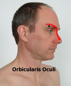 Orbicularis Oculi trigger points