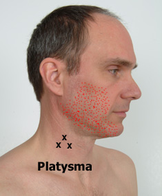 Platysma trigger points