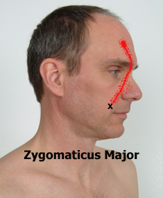 Zygomaticus Major trigger points