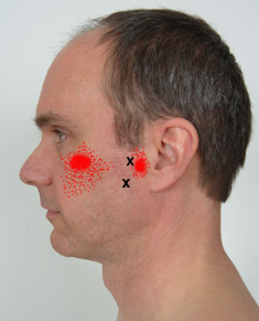 Lateral pterygoid trigger point referral patterns