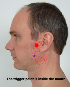 Medial Pterygoid trigger point referral patterns