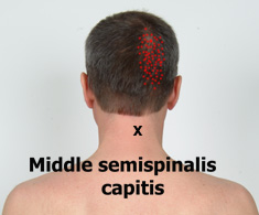 Middle semispinalis capitis trigger points
