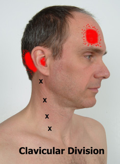 Sternocleidomastoid clavicular trigger points