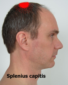 Splenius capitis referral pattern