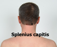 Splenius capitis trigger point