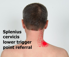 Splenius cervicis lower trigger point referral pattern