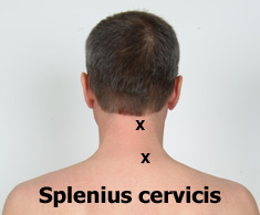 Splenius cervicis trigger points