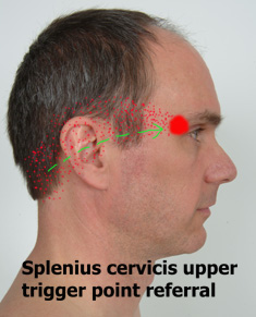 Splenius cervicis upper trigger point referral