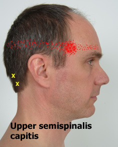 Upper semispinalis capitis referral pattern