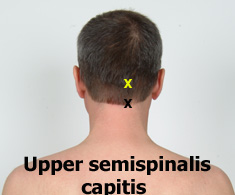 Upper semispinalis capitis trigger points