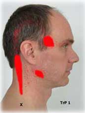 Trapezius Trigger Point Referral Patterns