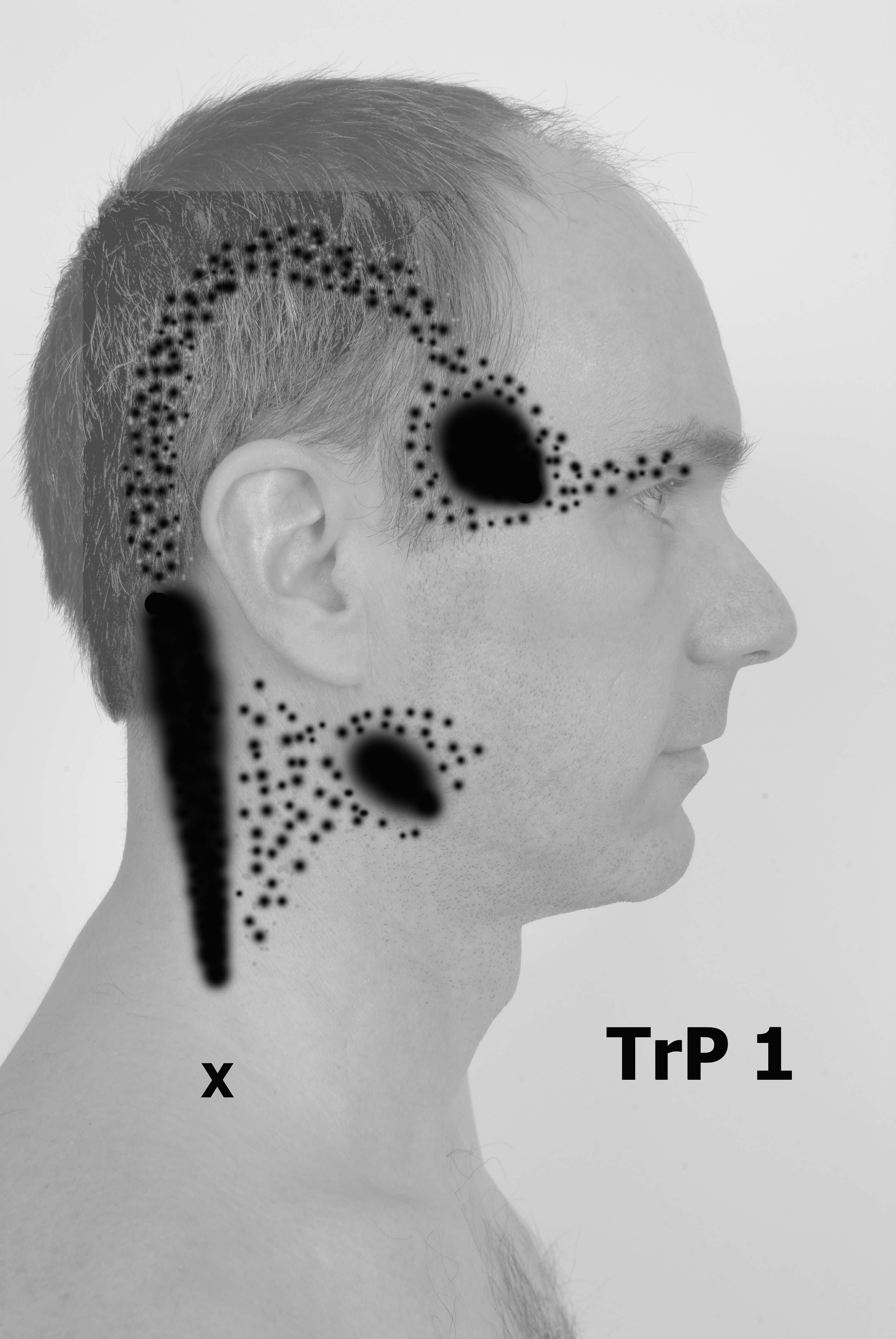 Trapezius Trigger Point 1 Referral Patterns - Black and White